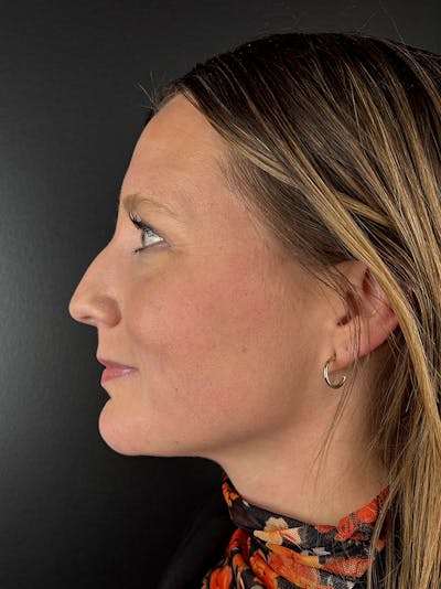 Liquid Rhinoplasty Before & After Gallery - Patient 429074 - Image 1