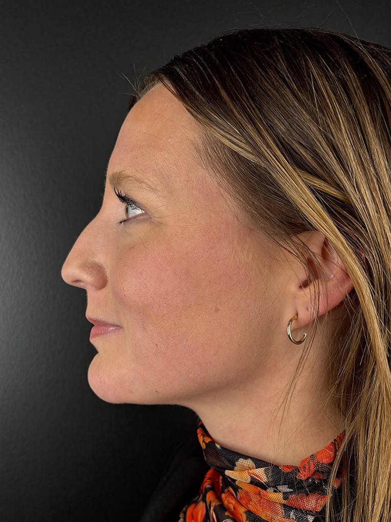 Liquid Rhinoplasty Before & After Gallery - Patient 429074 - Image 1