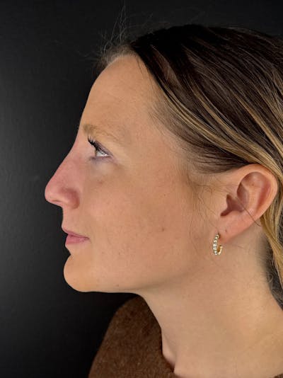 Liquid Rhinoplasty Before & After Gallery - Patient 429074 - Image 2
