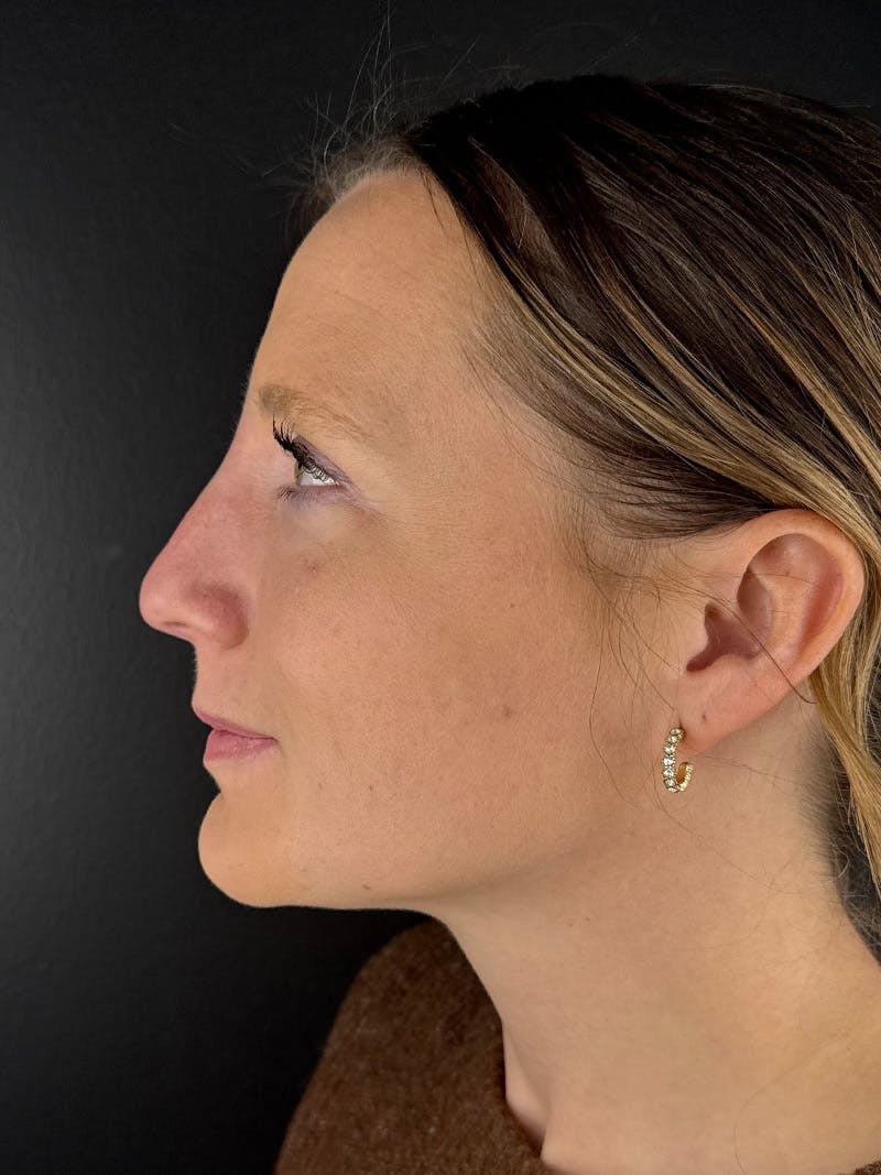 Liquid Rhinoplasty Before & After Gallery - Patient 429074 - Image 2