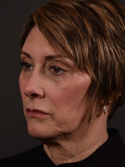 Full Facial Filler Before & After Gallery - Patient 219467 - Image 1