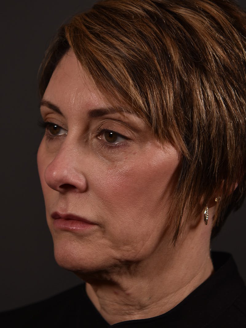 Full Facial Filler Before & After Gallery - Patient 219467 - Image 1