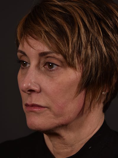 Full Facial Filler Before & After Gallery - Patient 219467 - Image 2