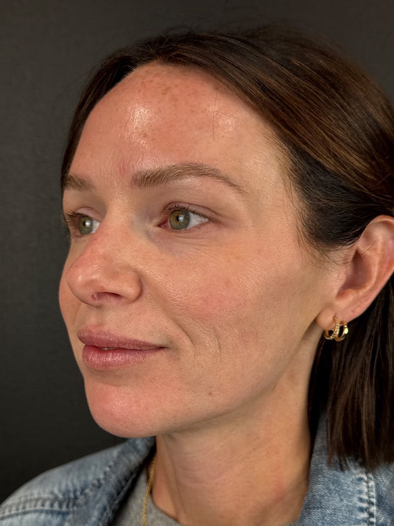 Full Facial Filler Before & After Gallery - Patient 187576 - Image 1