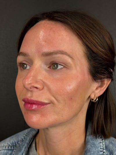 Full Facial Filler Before & After Gallery - Patient 187576 - Image 2