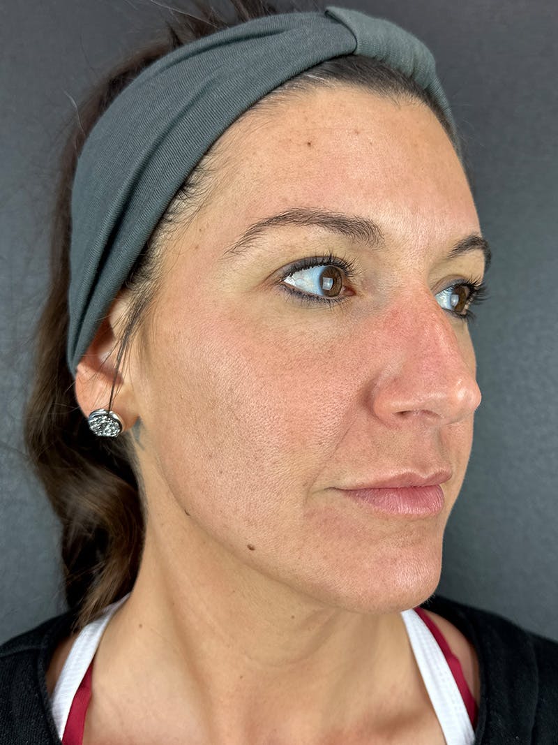 Cheek Filler Before & After Gallery - Patient 901937 - Image 1