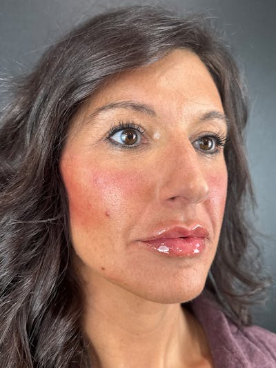 Cheek Filler Before & After Gallery - Patient 901937 - Image 2