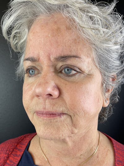 Cheek Filler Before & After Gallery - Patient 179203 - Image 1