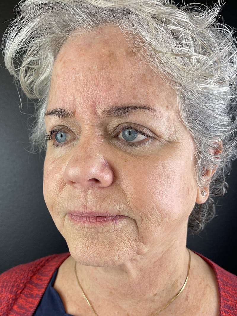 Cheek Filler Before & After Gallery - Patient 179203 - Image 1