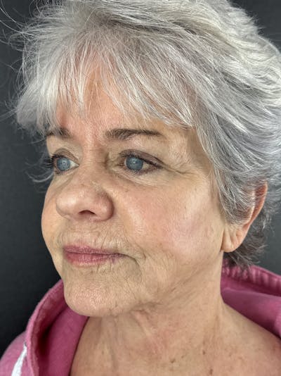 Cheek Filler Before & After Gallery - Patient 179203 - Image 2