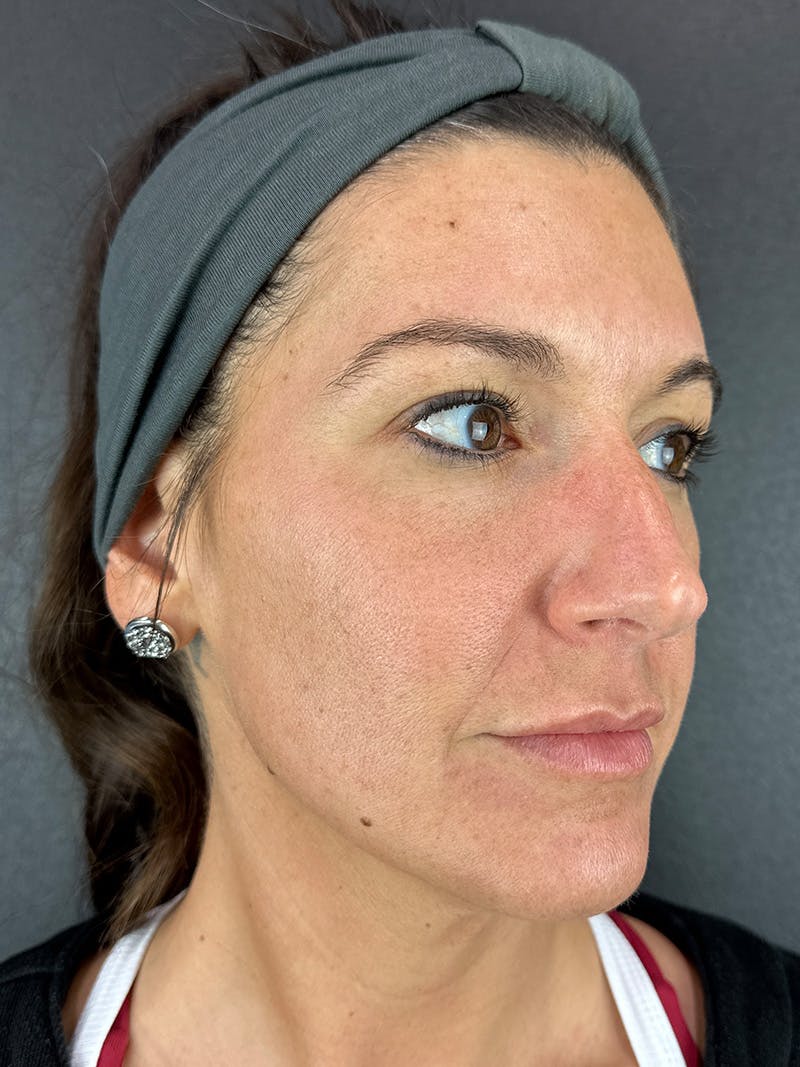 Lip Filler Before & After Gallery - Patient 238988 - Image 1