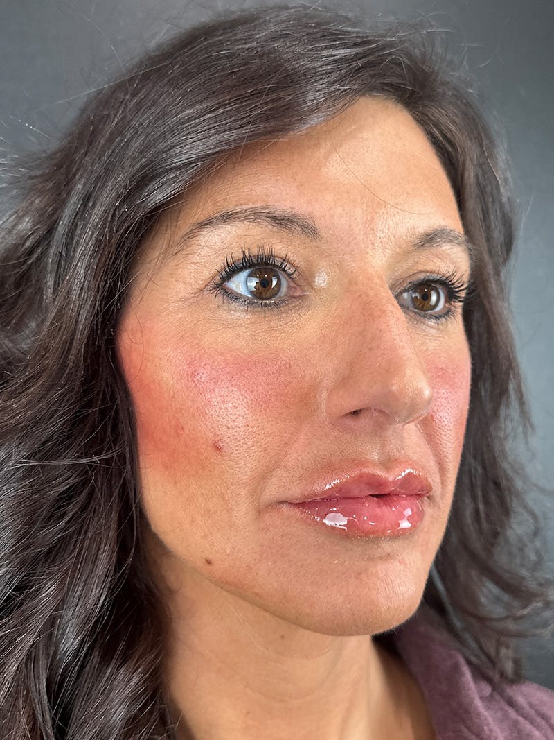 Lip Filler Before & After Gallery - Patient 238988 - Image 2