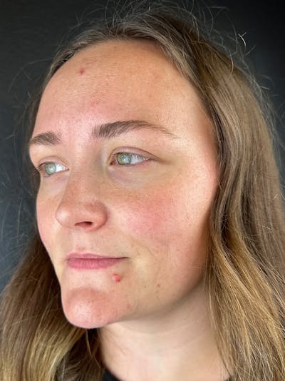 Lip Filler Before & After Gallery - Patient 276217 - Image 1