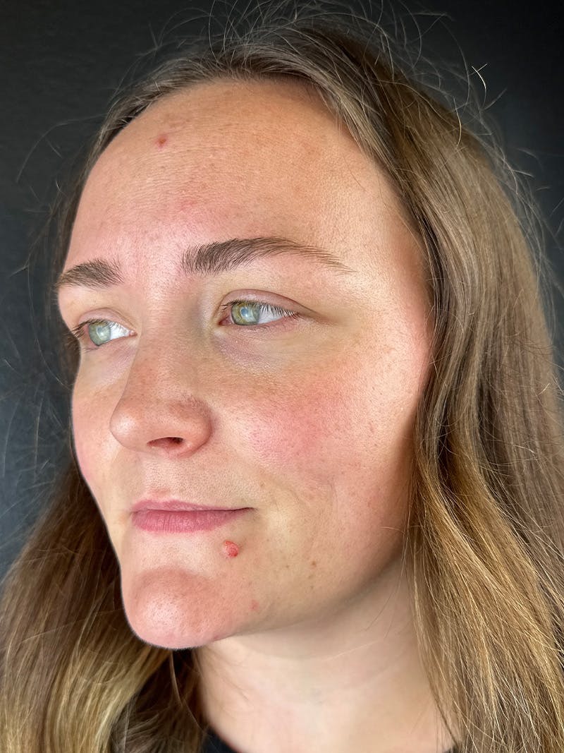 Lip Filler Before & After Gallery - Patient 276217 - Image 1