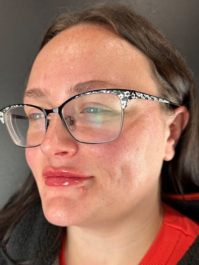 Lip Filler Before & After Gallery - Patient 276217 - Image 2