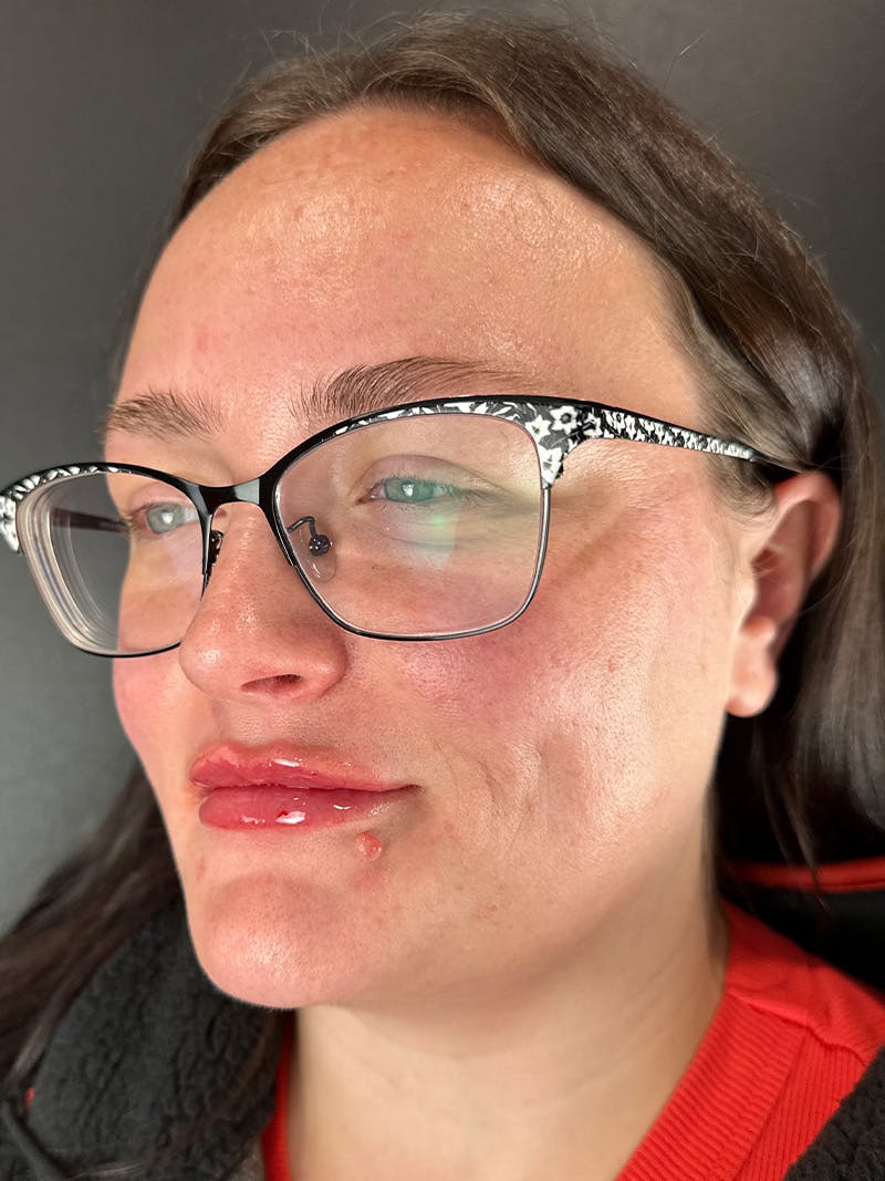 Lip Filler Before & After Gallery - Patient 276217 - Image 2