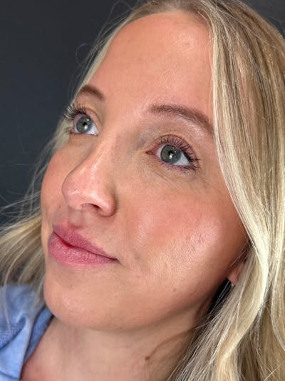 Lip Filler Before & After Gallery - Patient 412942 - Image 1