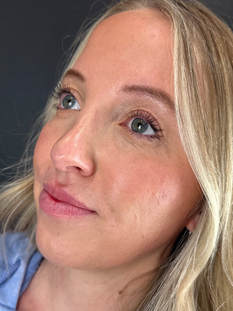 Lip Filler Before & After Gallery - Patient 412942 - Image 1