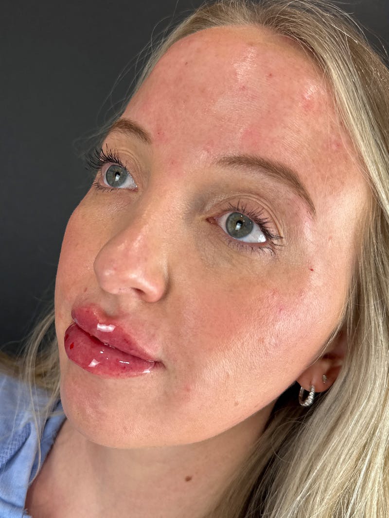 Lip Filler Before & After Gallery - Patient 412942 - Image 2