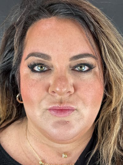 Lip Filler Before & After Gallery - Patient 375519 - Image 1