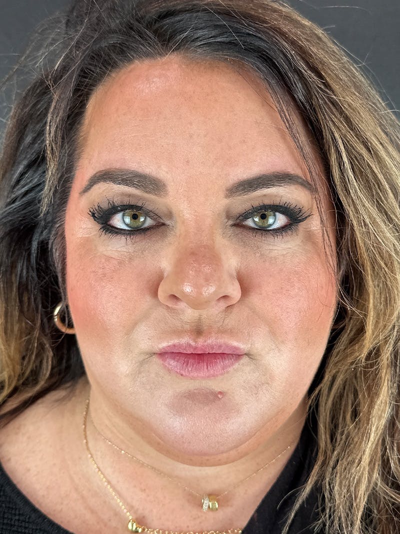 Lip Filler Before & After Gallery - Patient 375519 - Image 1