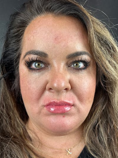 Lip Filler Before & After Gallery - Patient 375519 - Image 2