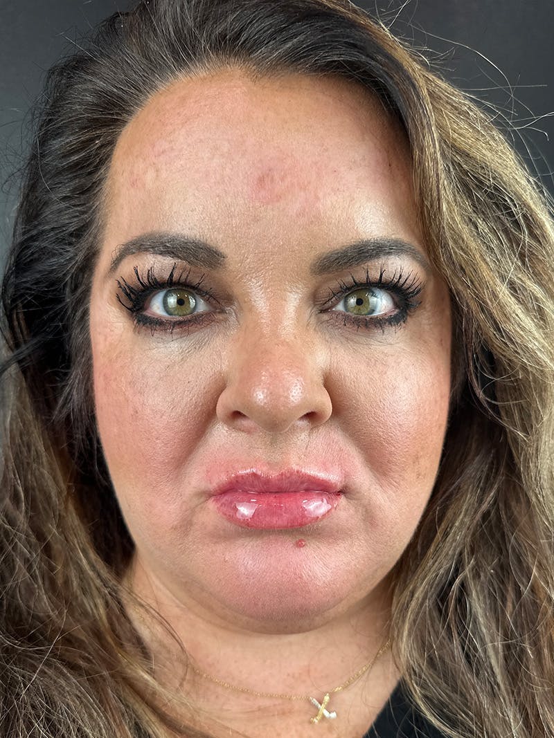 Lip Filler Before & After Gallery - Patient 375519 - Image 2