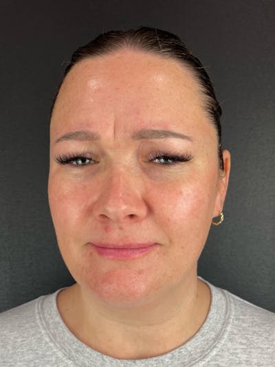 Wrinkle Relaxer Before & After Gallery - Patient 199337 - Image 1
