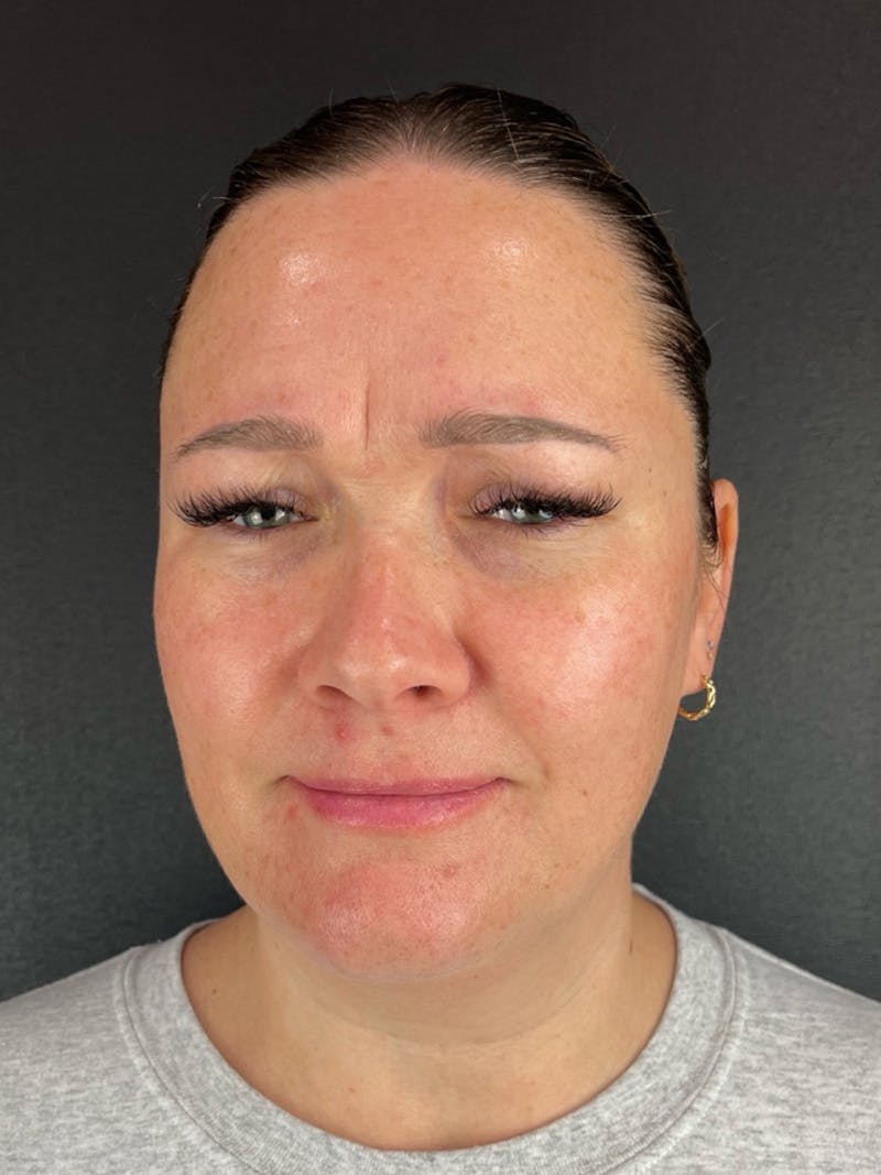 Wrinkle Relaxer Before & After Gallery - Patient 199337 - Image 1