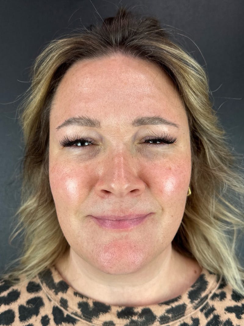 Wrinkle Relaxer Before & After Gallery - Patient 199337 - Image 2