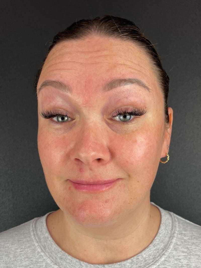 Wrinkle Relaxer Before & After Gallery - Patient 199337 - Image 3