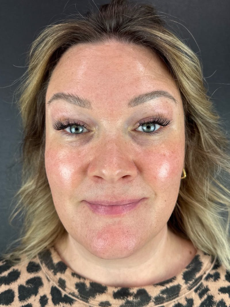Wrinkle Relaxer Before & After Gallery - Patient 199337 - Image 4