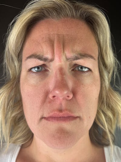 Wrinkle Relaxer Before & After Gallery - Patient 809820 - Image 1