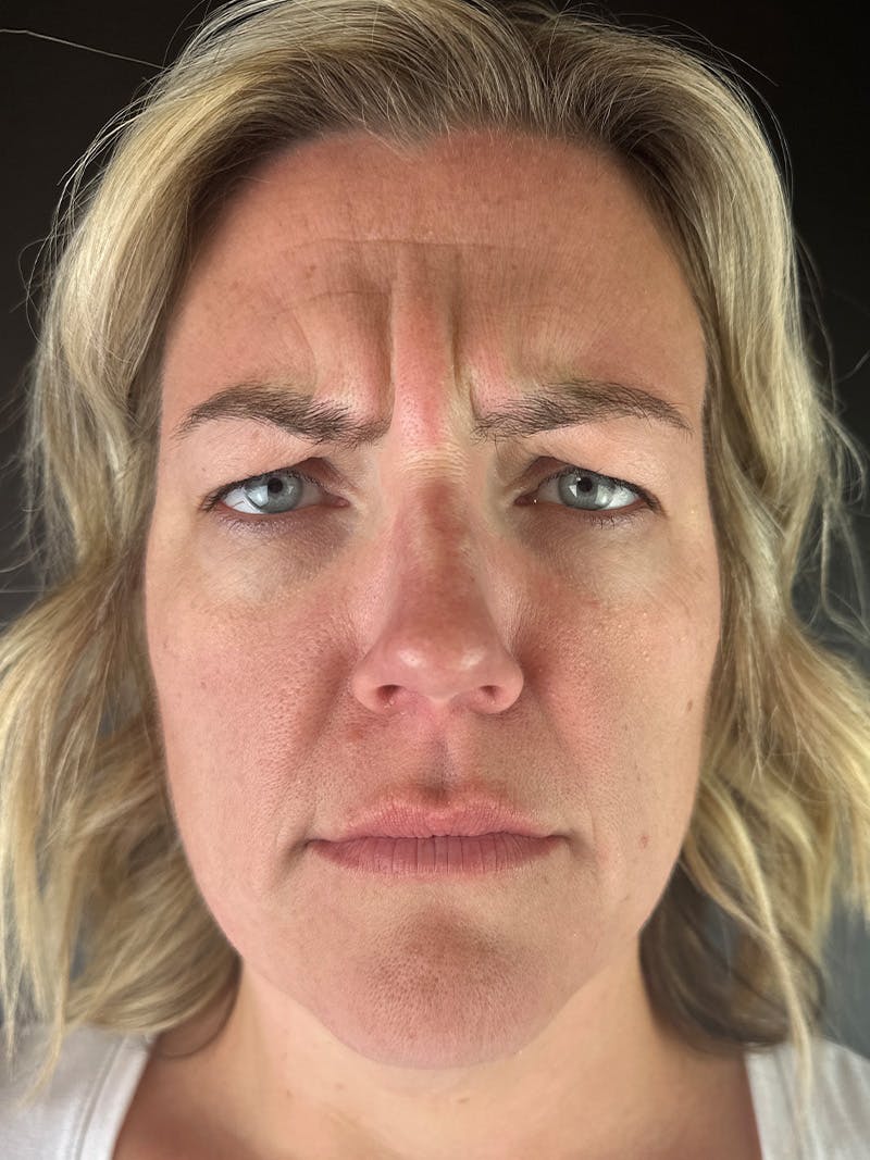 Wrinkle Relaxer Before & After Gallery - Patient 809820 - Image 1