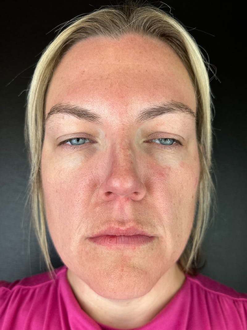 Wrinkle Relaxer Before & After Gallery - Patient 809820 - Image 2