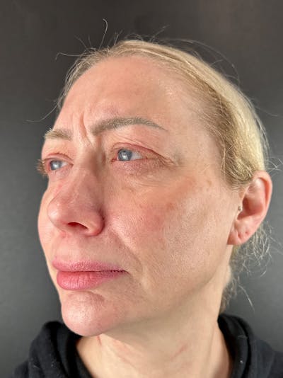 Wrinkle Relaxer Before & After Gallery - Patient 878298 - Image 1