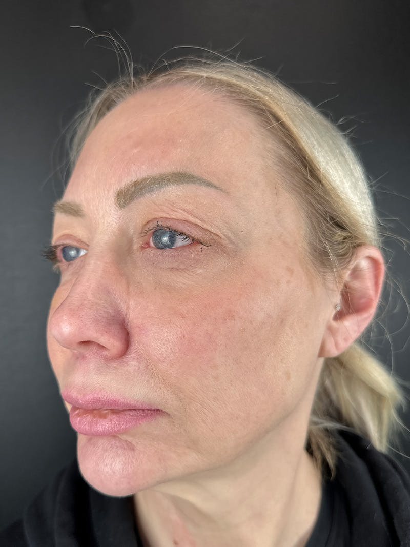 Wrinkle Relaxer Before & After Gallery - Patient 878298 - Image 2