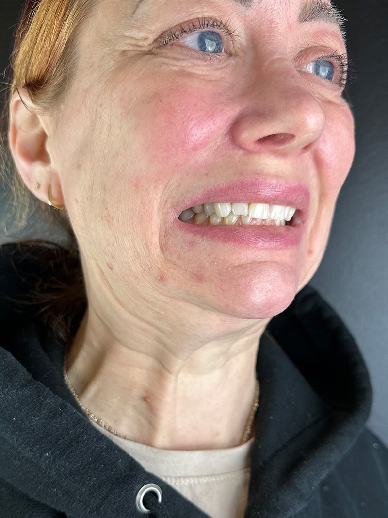 Wrinkle Relaxer Before & After Gallery - Patient 878298 - Image 3