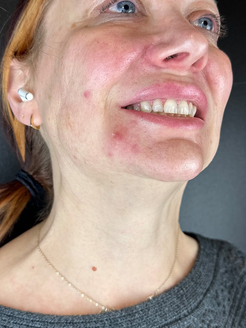 Wrinkle Relaxer Before & After Gallery - Patient 878298 - Image 4