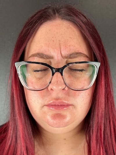 Wrinkle Relaxer Before & After Gallery - Patient 352395 - Image 1