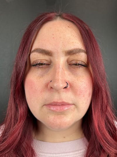 Wrinkle Relaxer Before & After Gallery - Patient 352395 - Image 2