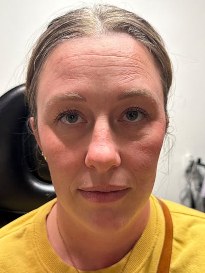 Wrinkle Relaxer Before & After Gallery - Patient 415059 - Image 1