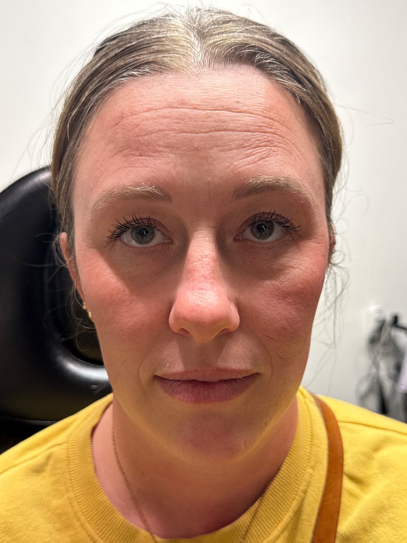 Wrinkle Relaxer Before & After Gallery - Patient 415059 - Image 1