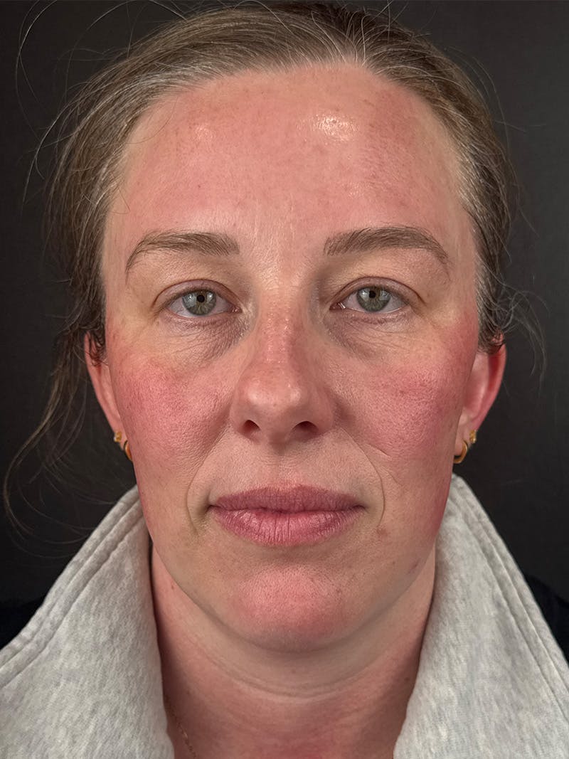 Wrinkle Relaxer Before & After Gallery - Patient 415059 - Image 2