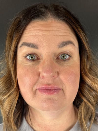 Wrinkle Relaxer Before & After Gallery - Patient 166447 - Image 1