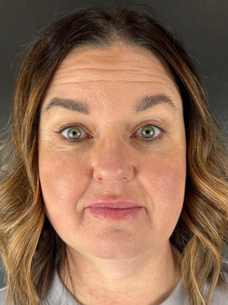 Wrinkle Relaxer Before & After Gallery - Patient 166447 - Image 1