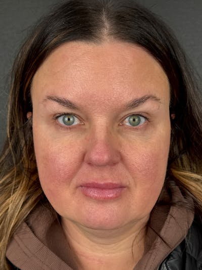 Wrinkle Relaxer Before & After Gallery - Patient 166447 - Image 2