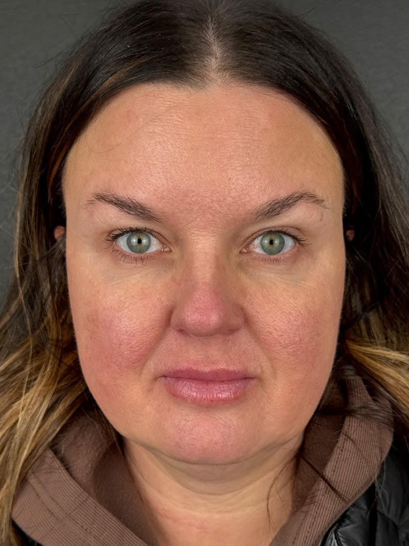 Wrinkle Relaxer Before & After Gallery - Patient 166447 - Image 2
