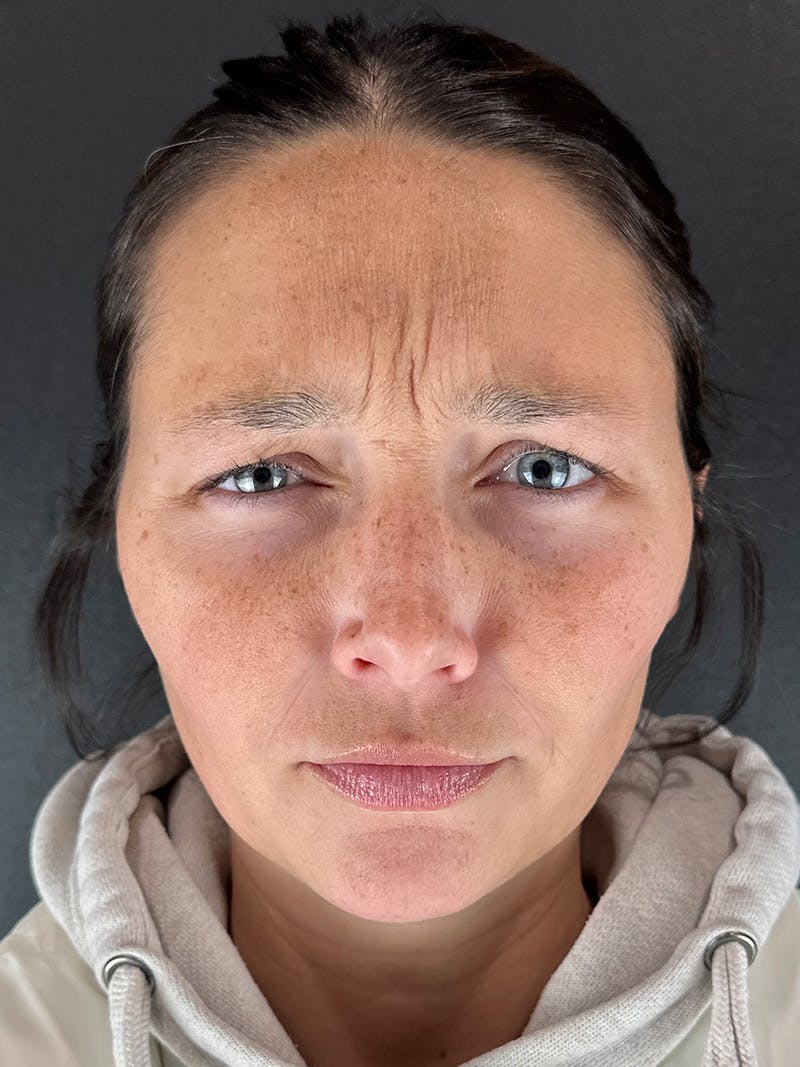 Wrinkle Relaxer Before & After Gallery - Patient 389809 - Image 1