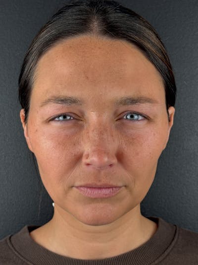 Wrinkle Relaxer Before & After Gallery - Patient 389809 - Image 2